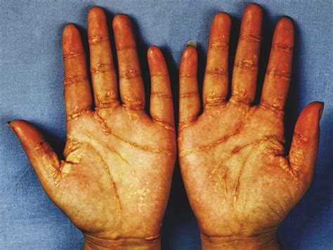 Xanthoma Palmaris