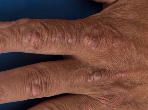 Xanthoma Tendinea