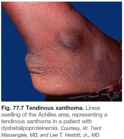 Xanthoma Tendinosa