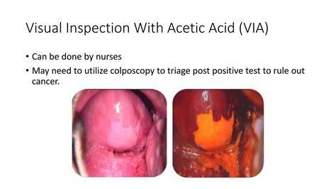 acetic acid test cervix