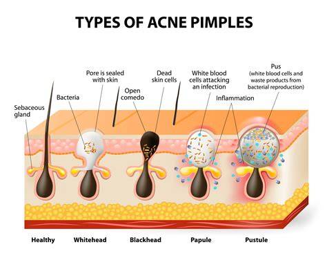 acne prone skin types