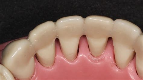 ada code for perio splint