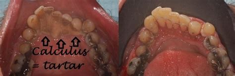 ada code for splinting teeth