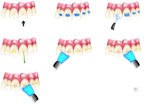 ada code for splinting teeth due to trauma