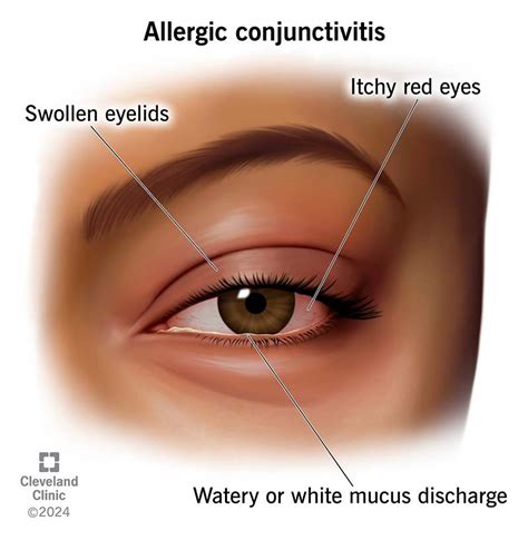 allergic conjunctivitis meaning in malayalam