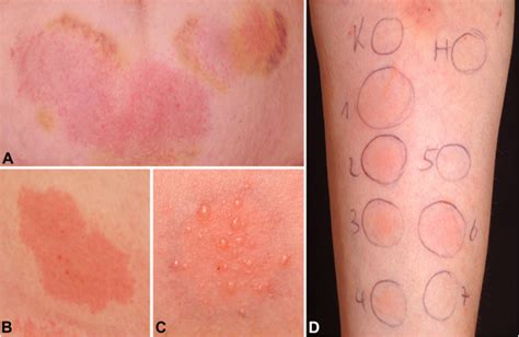 allergic reaction to subcutaneous injections