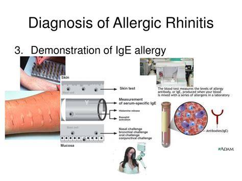 Illustration of allergy testing