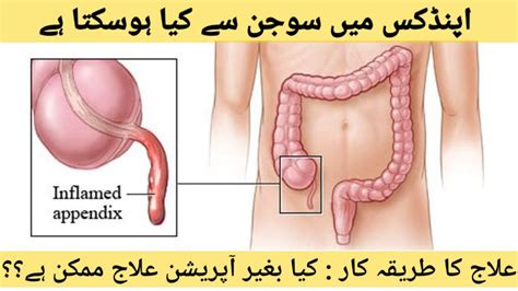 appendix meaning in urdu female with example