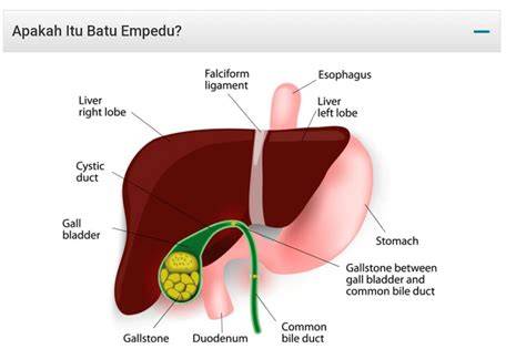 batu empedu