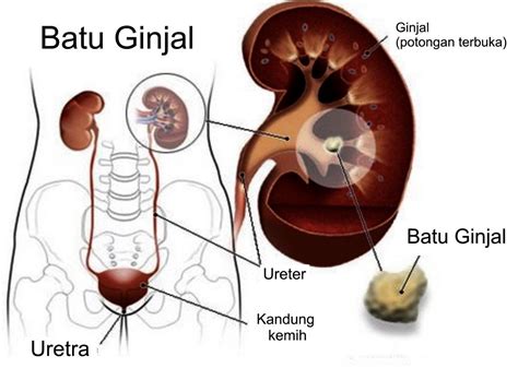 batu ginjal