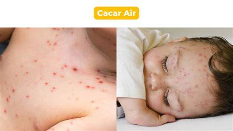 bayi cacar air