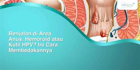 benjolan di anus