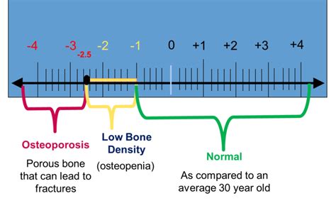Bone Density Score Chart