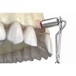 bone graft for periodontitis