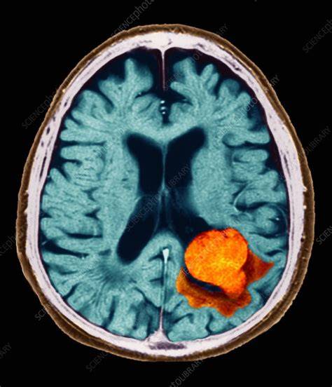 Brain scan showing lesion