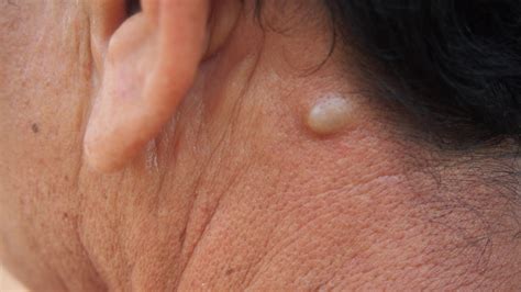 can a sebaceous cyst explode