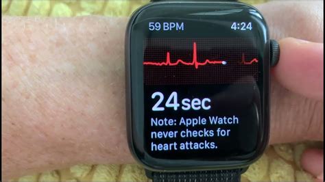 can apple watch ecg detect pvcs