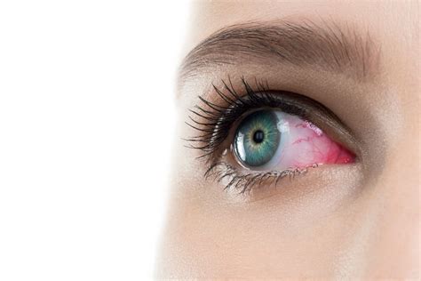 can contact get stuck in eyelid