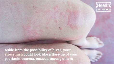 can i get stress rashes