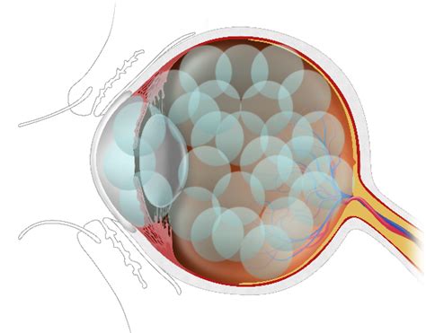 can multiple contacts get stuck in your eye