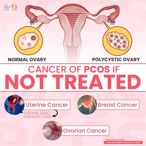 can pcos be left untreated