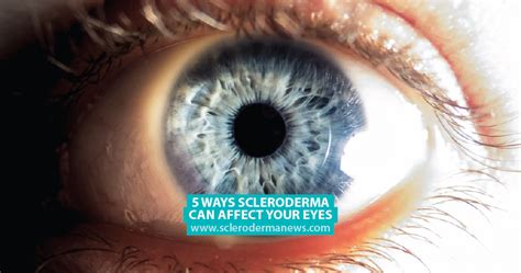 can scleroderma affect your eyesight