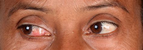 can scleroderma cause vision problems