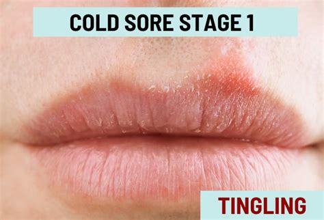 can you get a cold sore out of nowhere
