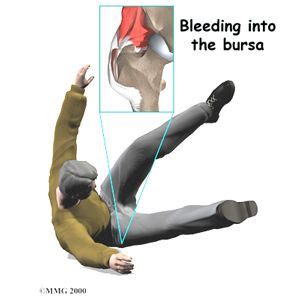 can you injure your it band in a fall