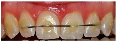 cdt code splinting teeth trauma