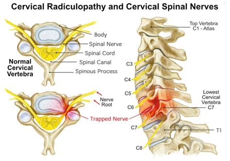 cervical nerve root compression anatomy