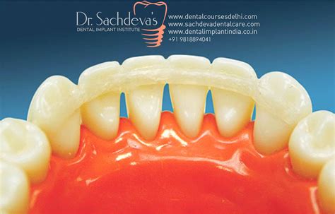 code for periodontal splint