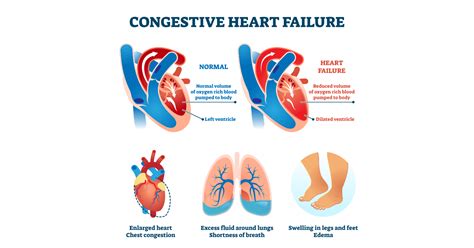 congestive heart failure type c