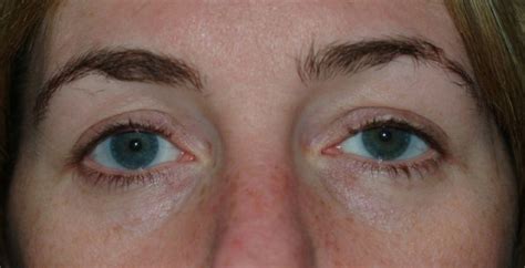 contact lens stuck behind eye for years