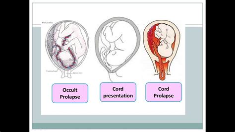 cord presentation definition in obg
