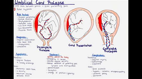 cord presentation vs cord prolapse