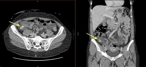 Diagnosis Apendisitis CT Scan