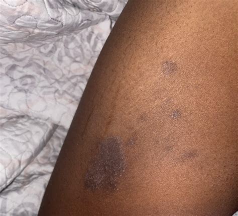dark patches inside thighs