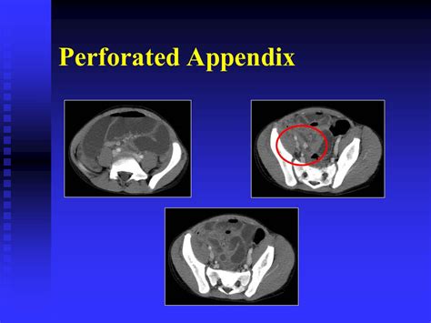 define perforated appendix