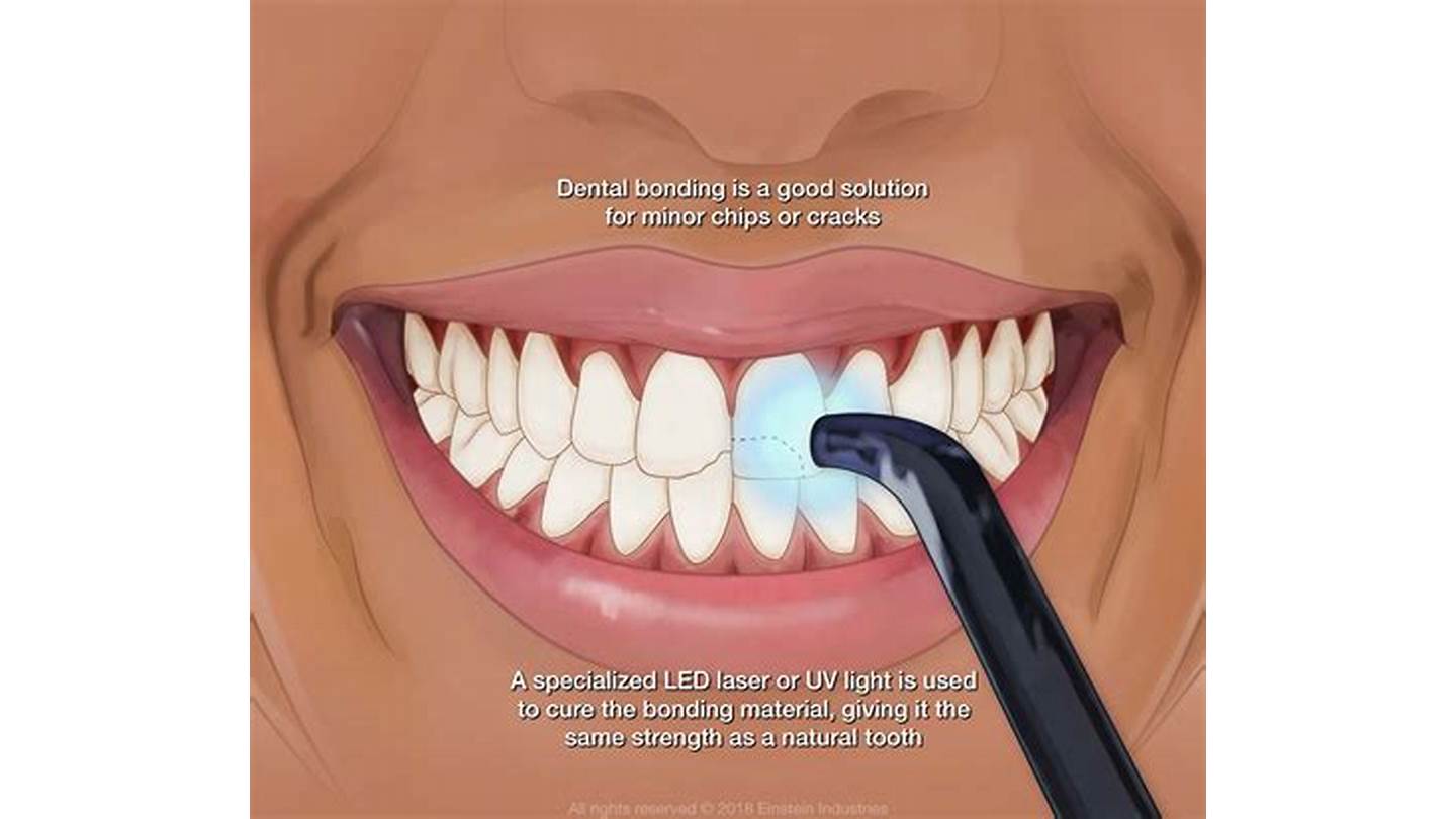 Dental bonding
