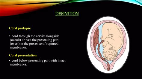 difference between cord prolapse and cord presentation