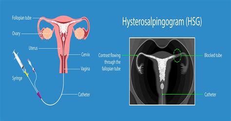 difference between hsg and sis