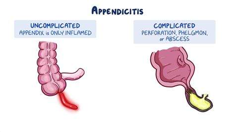 difference between perforated and ruptured appendix