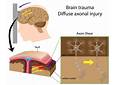 diffuse axonal injury