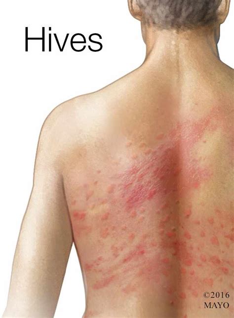 do stress hives come and go
