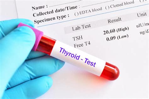 does a full blood count detect hypothyroidism