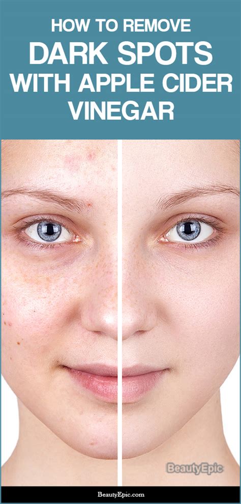 does apple cider vinegar help with hyperpigmentation