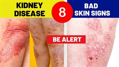 does poor kidney function affect skin