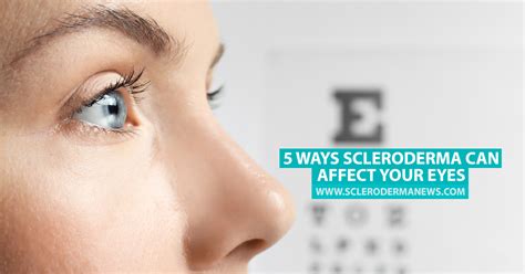 does scleroderma affect your vision