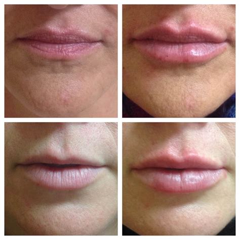 Before and After Dry Lips